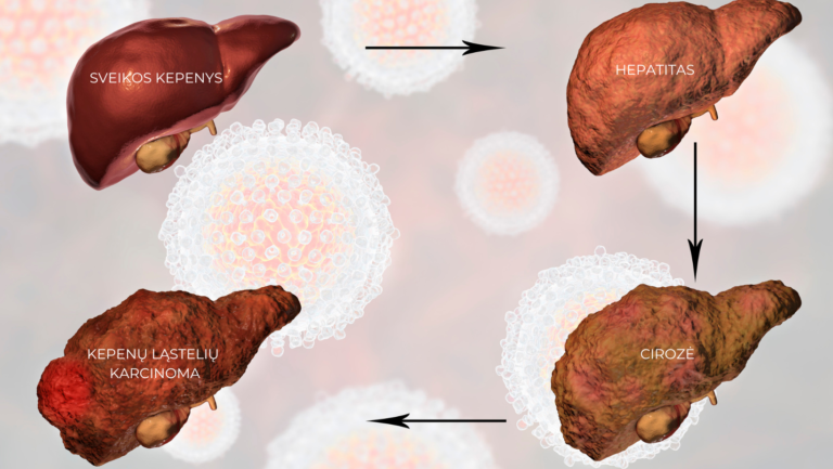 kepenų cirozė