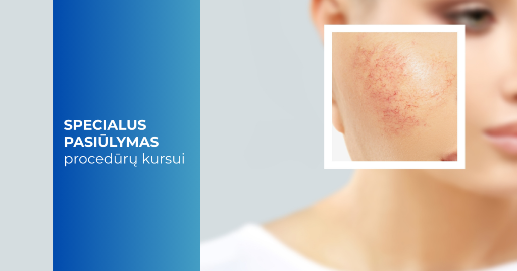 Kapiliarų gydymas lazeriu