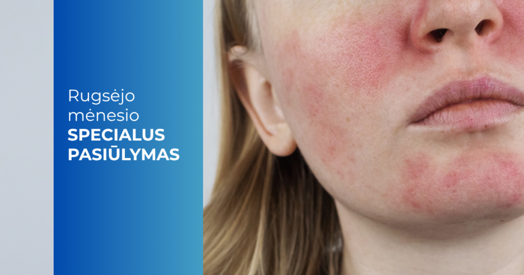 Rugsėjo mėn. pasiūlymas_Rožinės gydymas