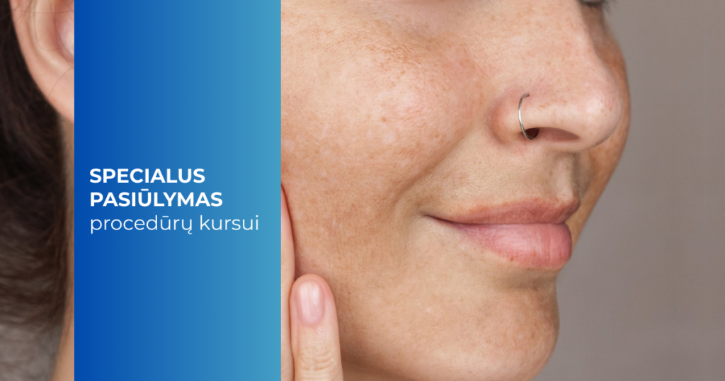 Pigmentinių dėmių gydymas lazeriu