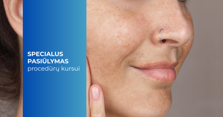 Pigmentinių dėmių gydymas lazeriu