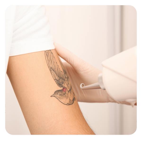 Tatuiručių šalinimas lazeriu Tatuiručių šalinimas lazeriu