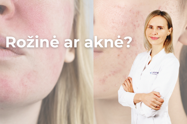 rožinė ar aknė