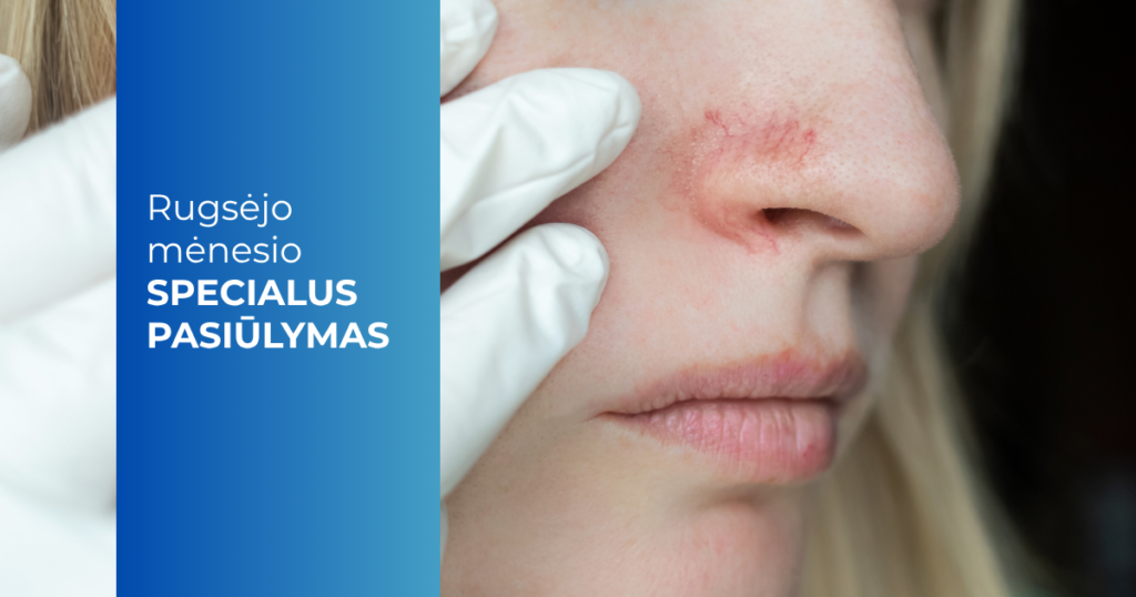 Rugsėjo mėn. pasiūlymas_Kapiliarų ir ir kraujagyslių šalinimas
