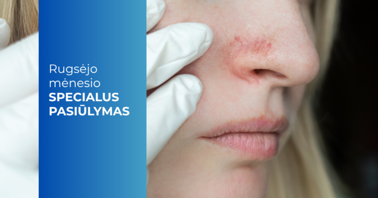 Rugsėjo mėn. pasiūlymas_Kapiliarų ir ir kraujagyslių šalinimas